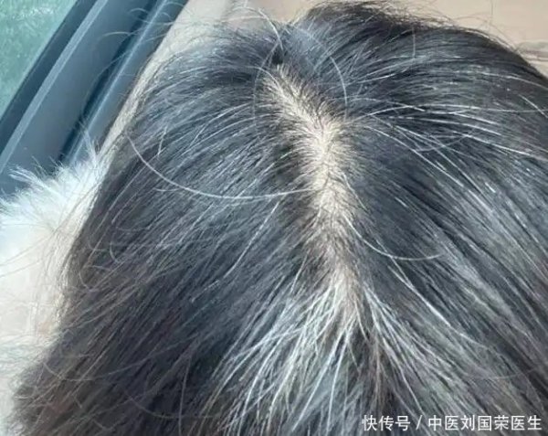 益上线 为什么白头发越长越多？你以为是老了，提醒：或是缺乏4种营养素